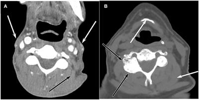 Evaluation of Neck Disability Using Computed-Tomography in Head and Neck Cancer Survivors